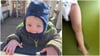Fieber und unscheinbarer Ausschlag: Zweijähriger überlebt Meningokokken-Infektion nur mit viel Glück